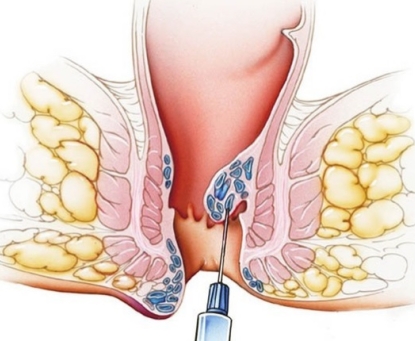 Bệnh trĩ có những phương pháp điều trị nào?